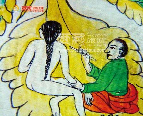 藏医放血疗法